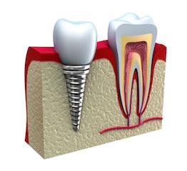 dental implant diagram | Dental Implants in Monroe MI | Kuras Dental Health Associates