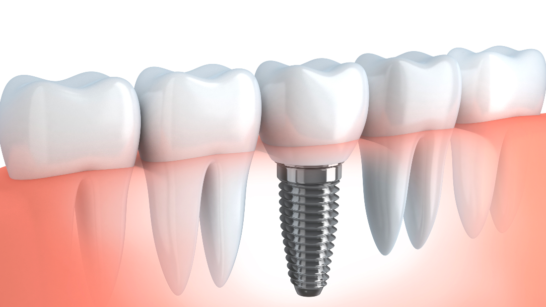 Monroe, MI Dentists Blog Caring for Your Dental Implant